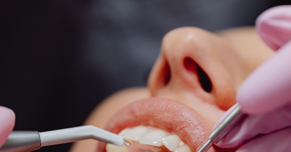 The Importance of Professional Supervision During Teeth Whitening